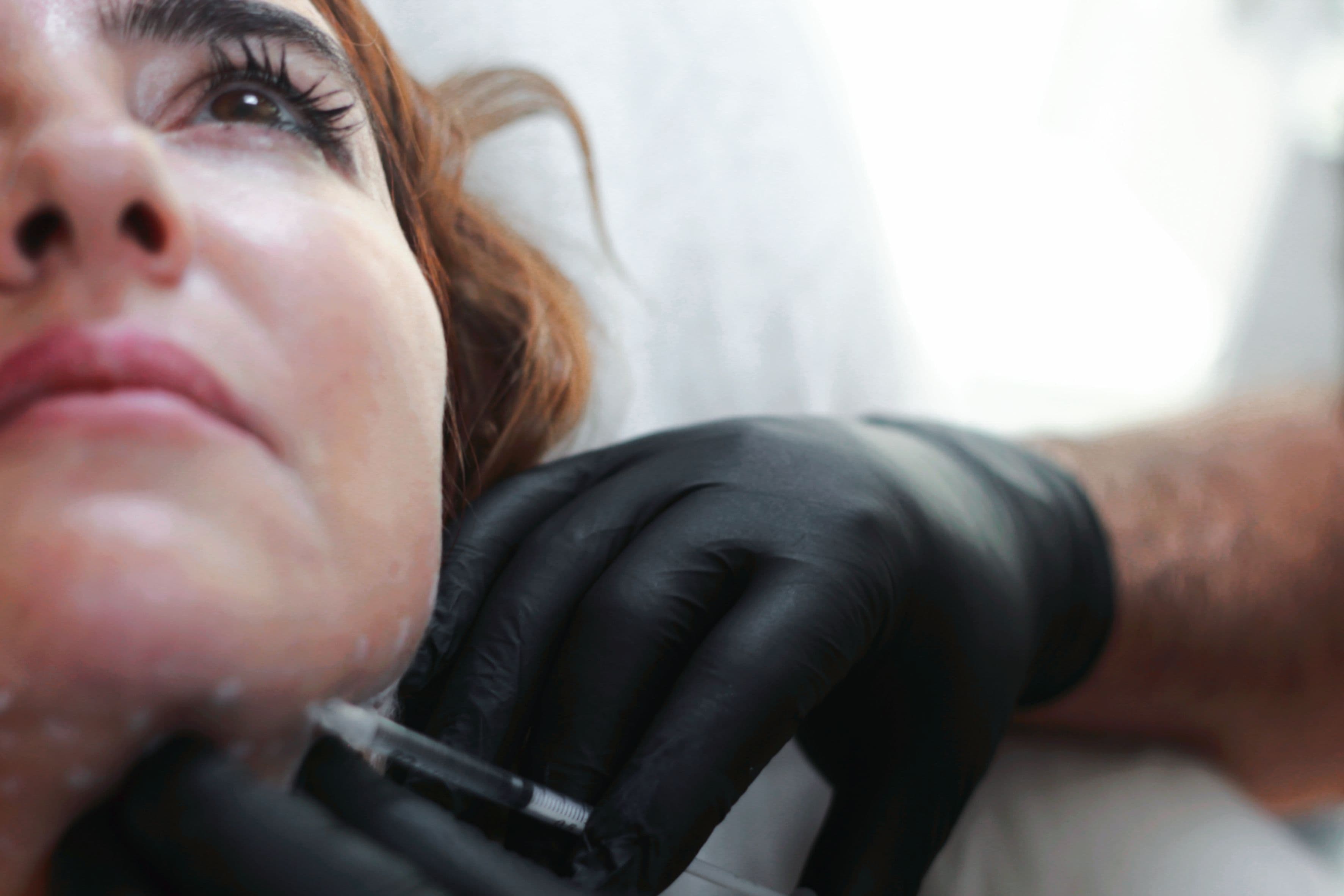 Dermal Fillers