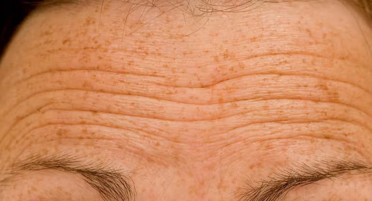 Forehead Lines treatment area
