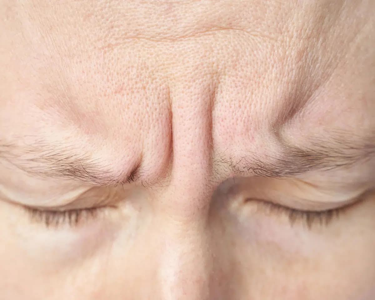 Frown Lines treatment area
